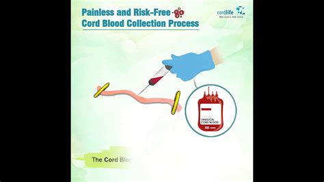 Cord Blood Collection Process - CordlifeIndia - YouTube