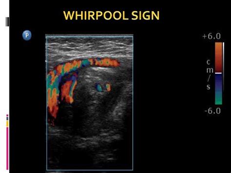 Midgut volvulus