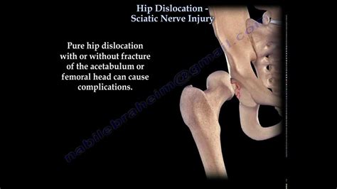 Hip Dislocation , Sciatic Nerve Injury - Everything You Need To Know ...