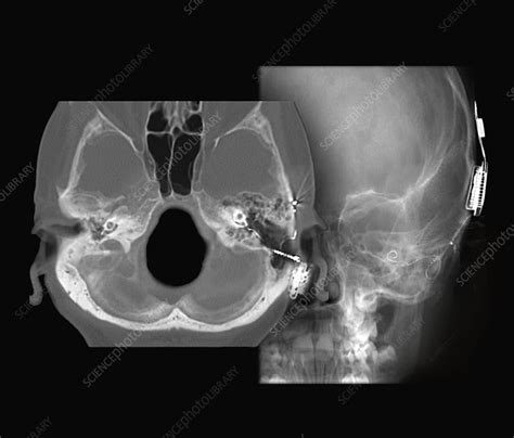 Cochlear implant, CT scan and X-ray - Stock Image - C048/0625 - Science Photo Library