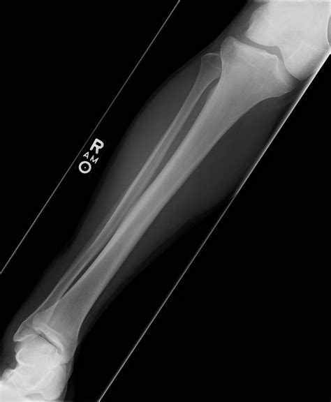 AP tibia & Fibula x-ray Diagram | Quizlet