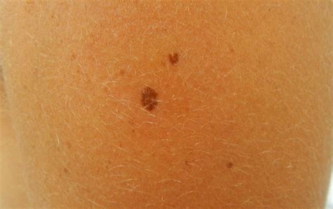 An Invasive Melanoma of Breslow Thickness of 0.4mm