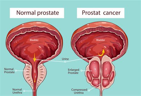 Prostate Gland Illustrations, Royalty-Free Vector Graphics & Clip Art - iStock