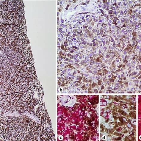 Fine needle biopsy specimen obtained from the lesion, showing an ...