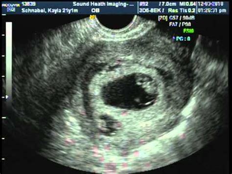 Ultrasound of Twins at 7 weeks - YouTube