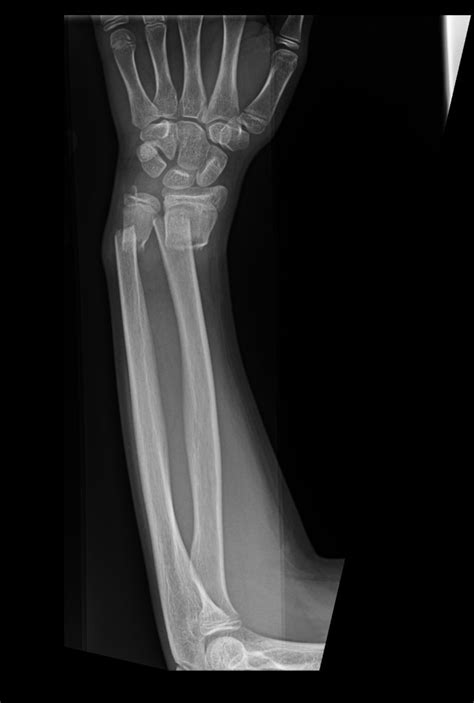 BROKEN ARM | Buyxraysonline