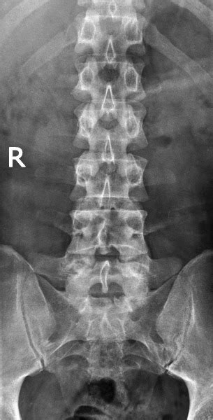 AP Lumbar Spine X-Ray Diagram | Quizlet