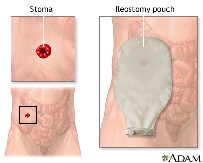 Ileostomy Information | Mount Sinai - New York