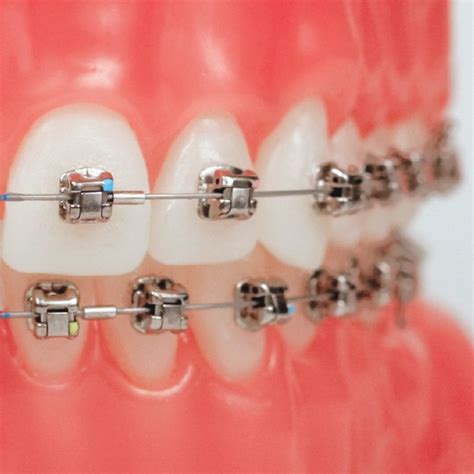 Damon Braces (Self-Ligating) – Neo Smiles Dental Studio