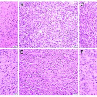 Examples of gastrointestinal stromal tumor histology include sclerosing... | Download Scientific ...