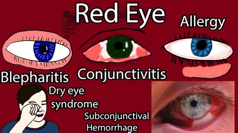 Red Eye Causes, Symptoms and Treatment. Pink eye causes - YouTube