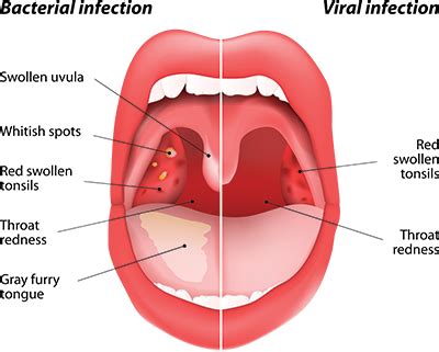 What are tonsils and adenoids and why do they need to be removed sometimes?