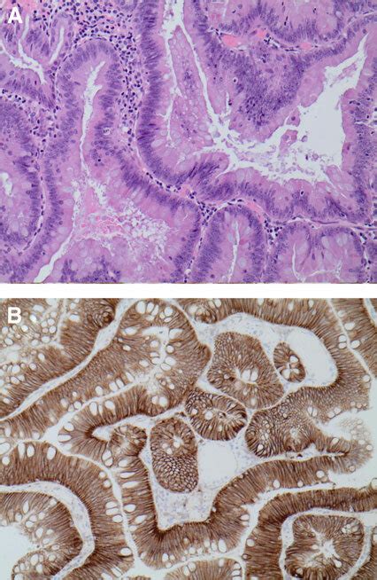 (A) High power view of the tubulovillous adenoma. It appears to be... | Download Scientific Diagram