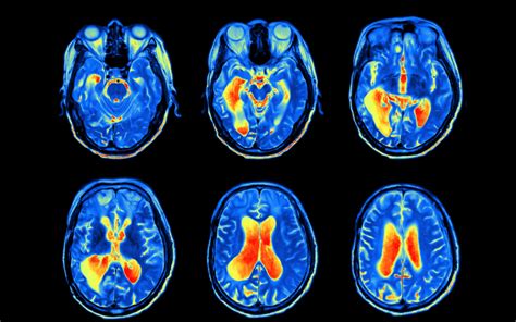 Neuroscience | UCL Research Domains - UCL – University College London