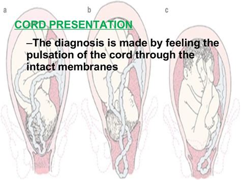 Cord prolapse