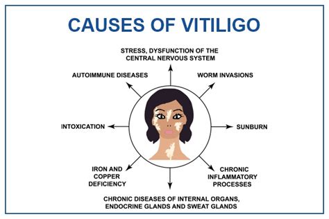 Vitiligo: Types, Causes, Treatment, Prevention | Medicover Hospitals