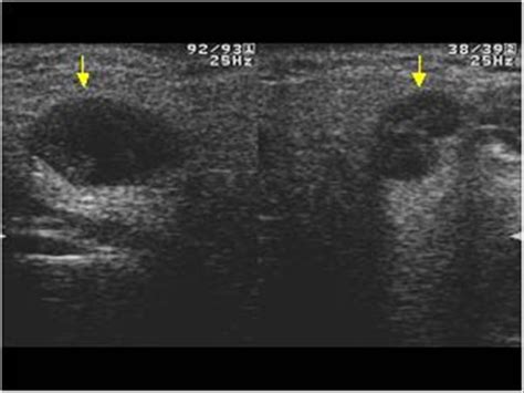 Head and Neck | 4.3 Salivary glands : Case 4.3.4 Warthin's tumors | Ultrasound Cases