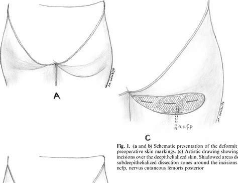 Figure 1 from Correction of Buttock Ptosis with Anchoring Deepithelialized Skin Flaps | Semantic ...