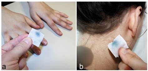 Infectious Pseudochromhidrosis: A Case Report and Literature Review ...