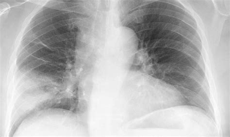Cheap, quick test identifies major risks for pneumonia patients • healthcare-in-europe.com