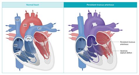 Congenital Heart Defects Symptoms