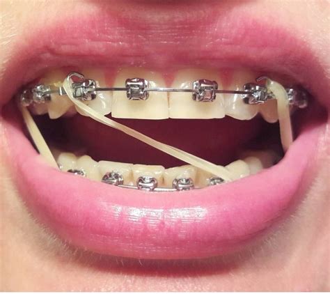 How To Put Rubber Bands On Braces Triangle – Dunya led