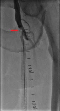 Treatment of Symptomatic Common Femoral Artery Stenosis