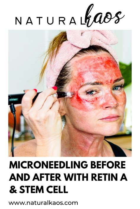 Pin on Microneedling