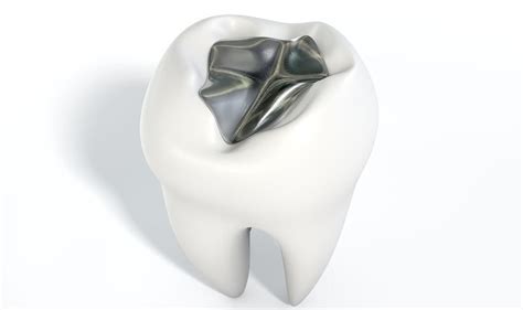 Silver Fillings vs. White Fillings - Advanced Family Dentistry Tucson Arizona