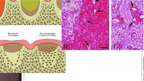 Extraction socket healing and Dry socket - YouTube