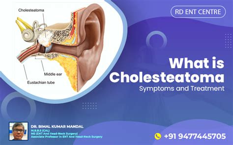 What is Cholesteatoma- Symptoms and Treatment