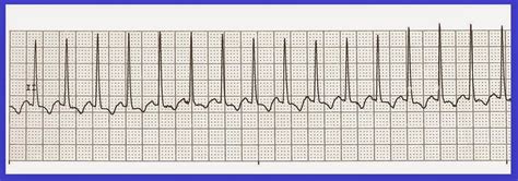 Float Nurse: Practice Rhythm Strips 302