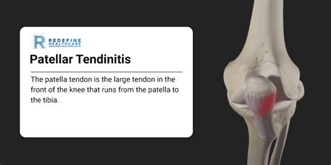 Patellar Tendinitis - NJ's Top Orthopedic Spine & Pain Management Center