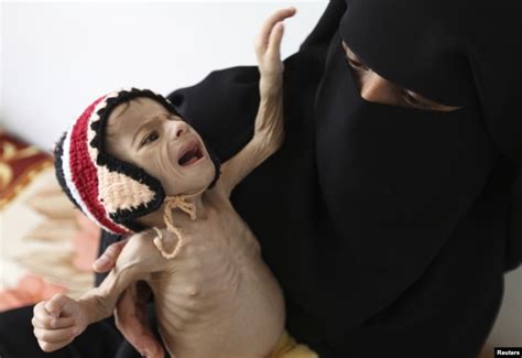 Yemen – Female Faces of Hunger & Malnutrition