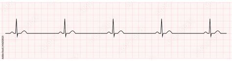 EKG Showing Sinus Bradycardia of Patient Stock Vector | Adobe Stock