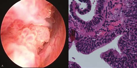 Cauliflower-like tumor of posterior urinary tract (A) and biopsy with... | Download Scientific ...