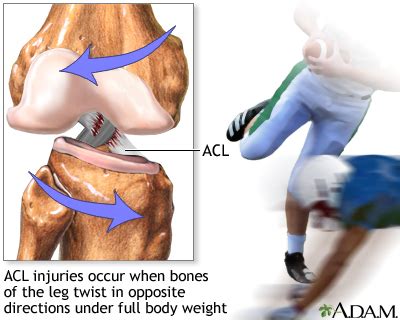 Anterior cruciate ligament (ACL) injury Information | Mount Sinai - New York