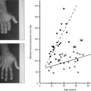 The left panels show the brachydactyly (type E) from an aVected person ...