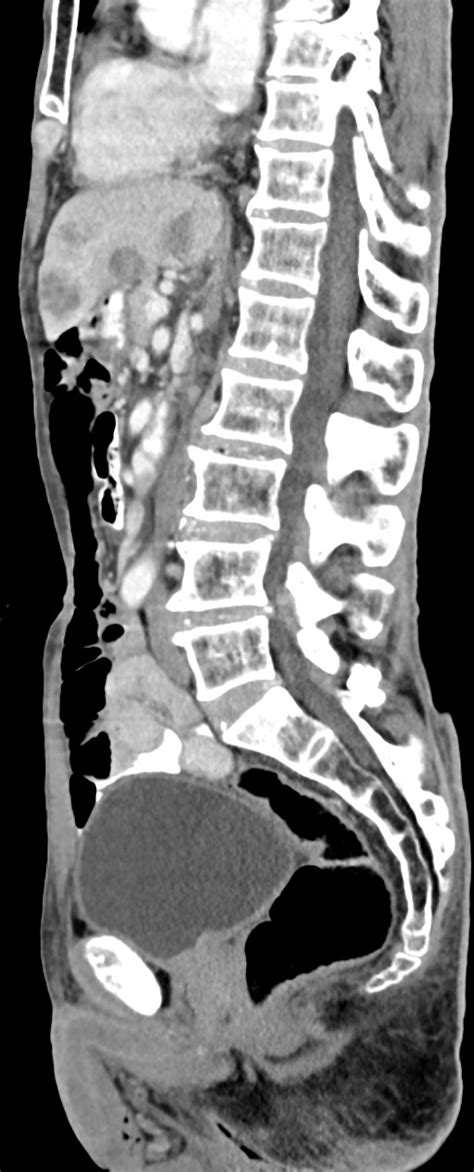 Gastroesophageal junction adenocarcinoma with liver metastases | Image ...