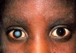 Cataract, Main Cause Of Infant Blindness - Opthalmologist