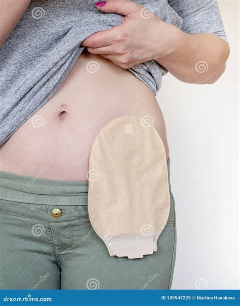 Front View on Colostomy Pouch in Skin Color Attached To Woman Patient ...