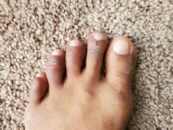 Chilblains: Causes, Symptoms and Treatment | Sanders Podiatry Clinics