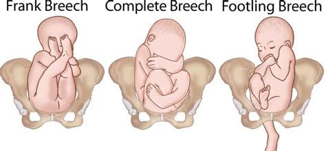 Breech Baby at 32 Weeks | New Health Advisor