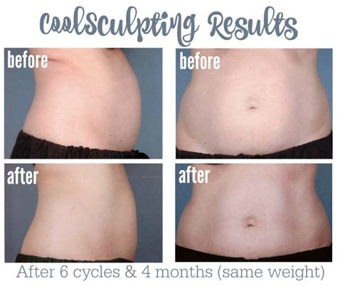 CoolSculpting Before & After Results