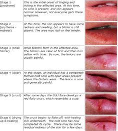 13 Ways to Get Rid of Cold Sores | Dr. Axe Articles/Healthy Living | Cold sore, Sore in mouth ...