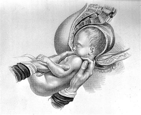 The Dangerous Allure of Breech Birth at Home – and a Problematic New Paper – The Seattle Star