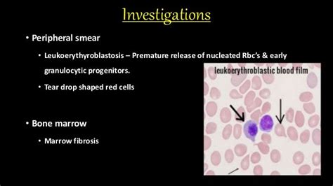 Myeloproliferative disorder