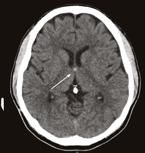 Colloid cyst of the 3rd ventricle: significance and management ...