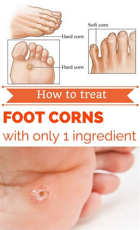 How To Treat Foot Corns With Only 1 Ingredient | Get rid of corns, Corn ...