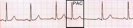 Paramedic Student Central: PAC, PVC, PJC